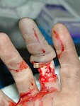 Nošení prstýnku je velmi nebezpečné